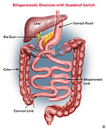 Duodenal Switch - Expected weight loss 80-90% of excess weight