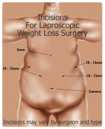 Laproscopic Bariatric Surgery Incisions