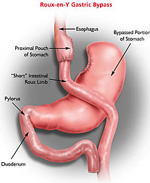 Roux-en-Y Gastric Bypass Procedure 