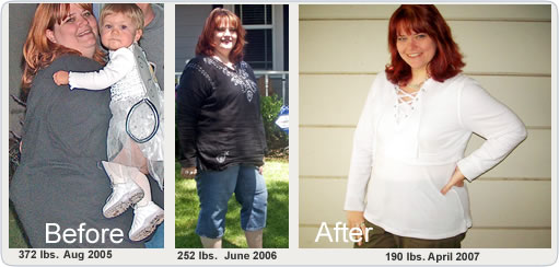 Weight Loss Surgery Before and After Pictures - Vertical Gastrectomy