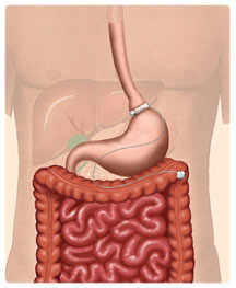 LAP-BAND Adjustable Gastric Band 
