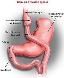 Roux-en-Y Gastric Bypass Procedure 