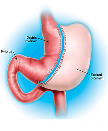 Vertical Gastrectomy